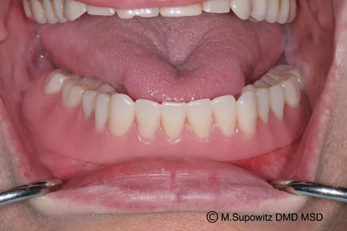 Patient's mouth after dental implants