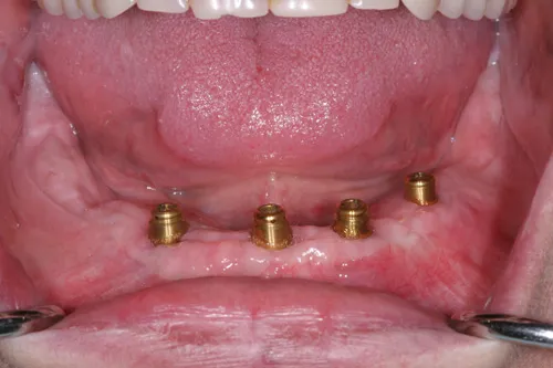 Patient's mouth before dental implants