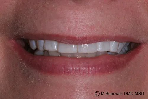 Patient's mouth after esthetic reshaping