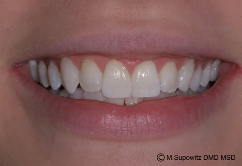 Patient's mouth after esthetic reshaping