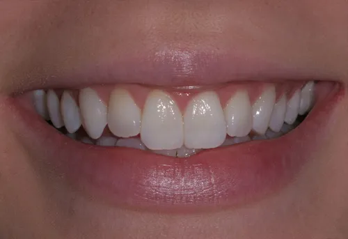 Patient's mouth before esthetic reshaping