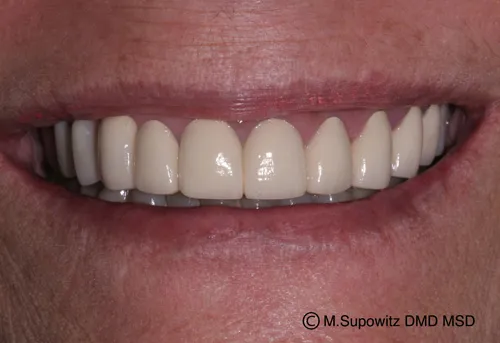 Patient's mouth after dental partials