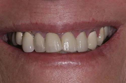 Patient's mouth before dental partials