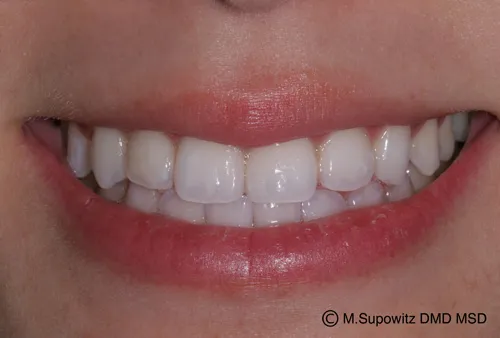 Patient's mouth after teeth whitening