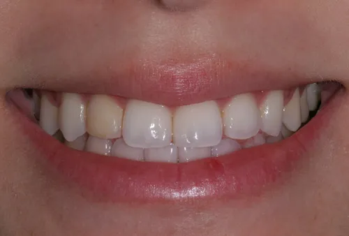 Patient's mouth before teeth whitening