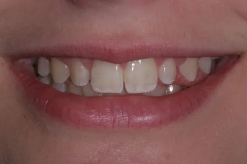 Patient's mouth before teeth whitening