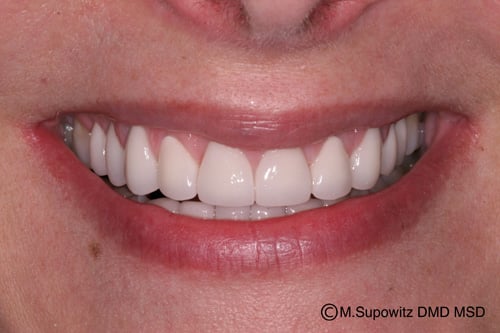 Patient's mouth after porcelain veneers