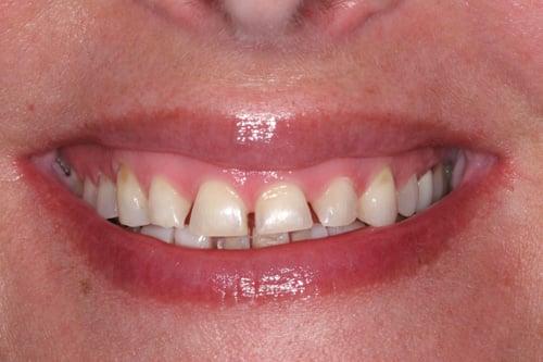 Patient's mouth before porcelain veneers