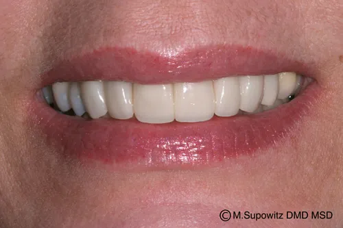 Patient's mouth after porcelain veneers
