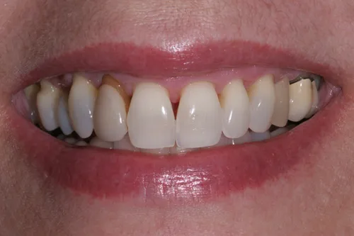 Patient's mouth before porcelain veneers