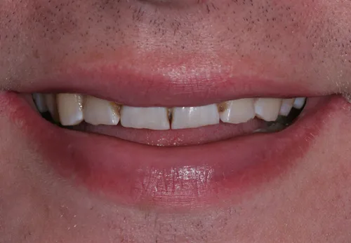 Patient's mouth before porcelain veneers