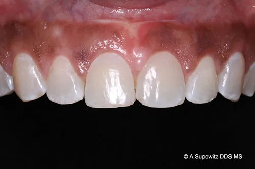 After periodontal plastic surgery