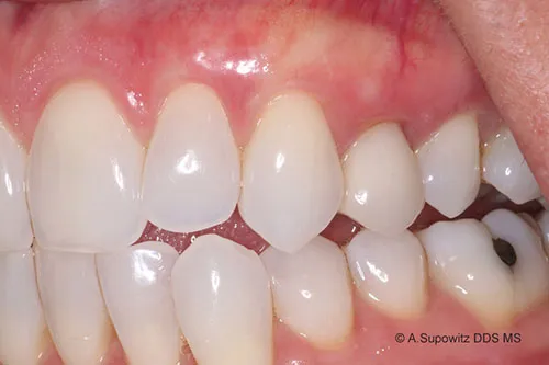 After periodontal plastic surgery