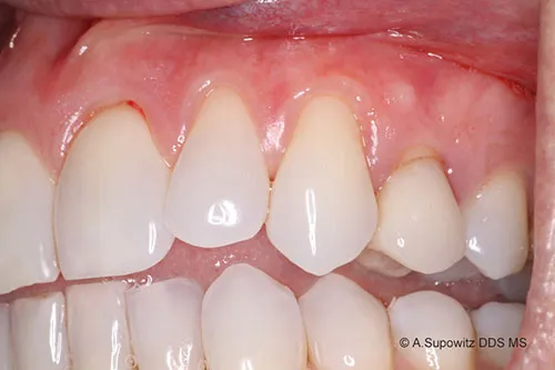 Before periodontal plastic surgery