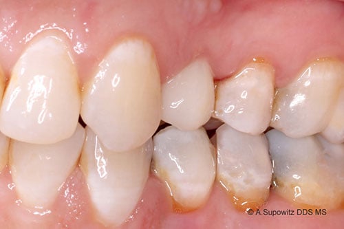 After Immediate Implants