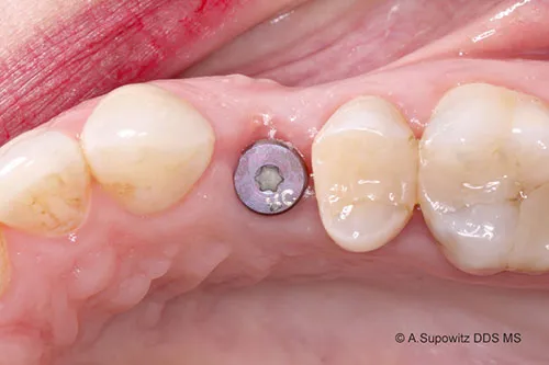 After Immediate Implants