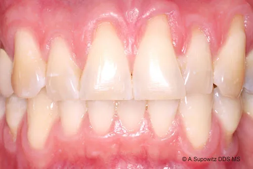 Before periodontal plastic surgery