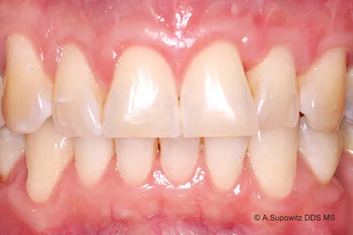 After periodontal plastic surgery