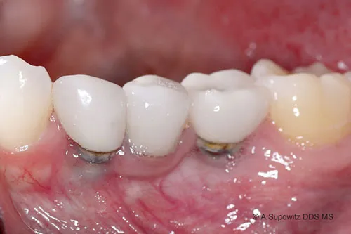 Before Implant Gum Recession width=