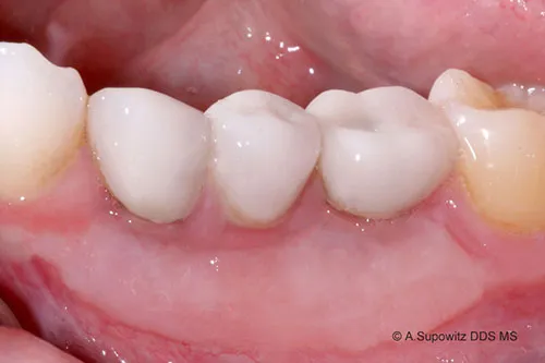 After Implant Gum Recession