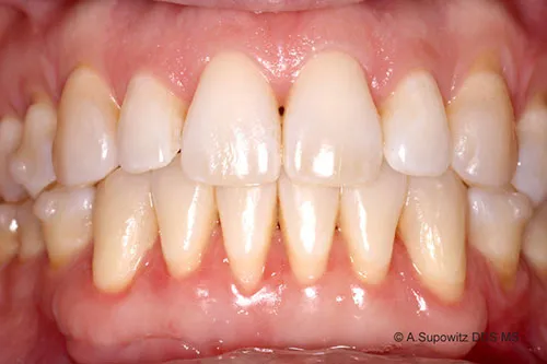 After gum graft