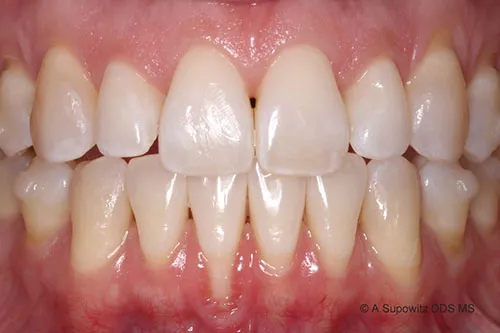 Before gum graft