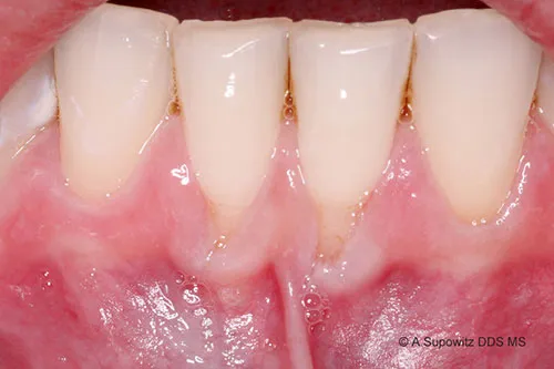 Before gum graft