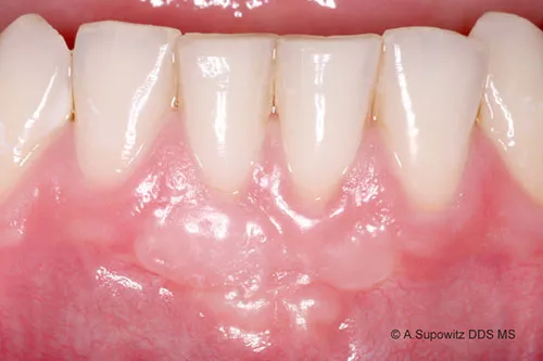 After gum graft