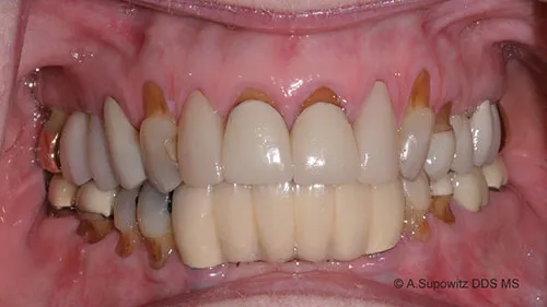Before periodontal plastic surgery