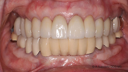After periodontal plastic surgery