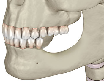 bone grafting