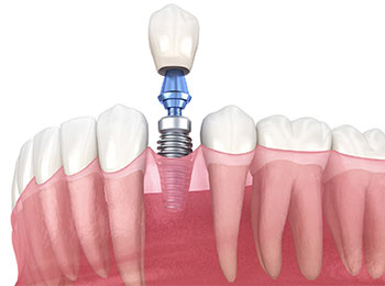 dental implant illustration