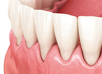 gum grafting lower