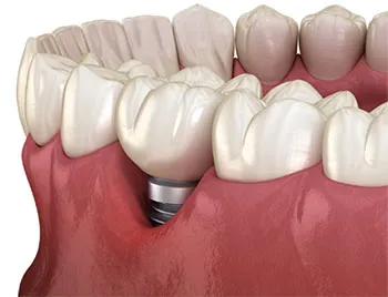 implant gum recession