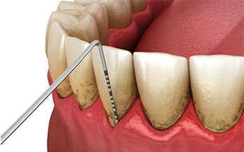 Periodontal disease