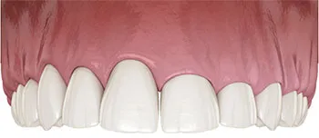 periodontal plastic surgery upper teeth