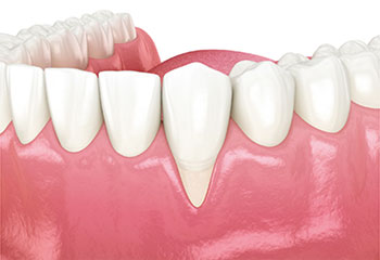 periodontal plastic surgery lower teeth