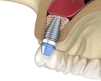 Sinus Augmentation