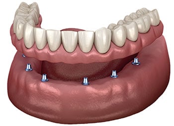 snap on denture