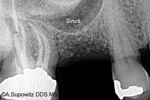 Before Sinus Augmentation