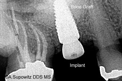 After Sinus Augmentation Implant placed