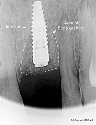 after bone graft