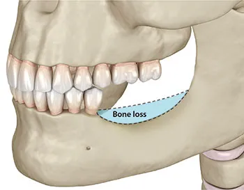 bone grafting