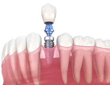 immediate implants illustration